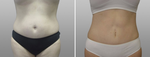 Abdominoplasty (Tummy Tuck) images, patient 15, front view