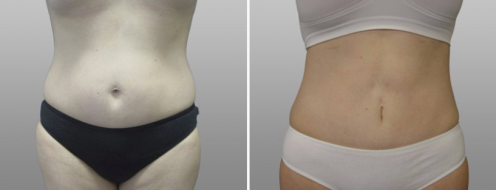Tummy Tuck Photos 74 Abdominoplasty (Tummy Tuck)before and after photos post-op 6 weeks, patient 15, front view