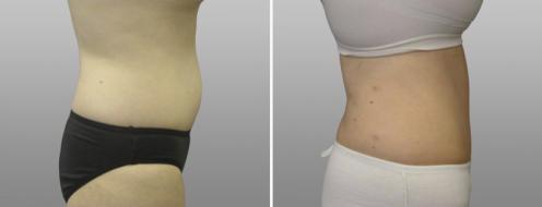Tummy Tuck Photos 73 Patient Abdominoplasty (Tummy Tuck) before and after photos post-op 6 weeks, image 41, side view