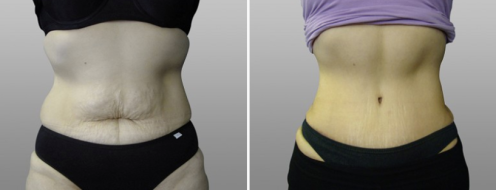 Tummy Tuck Photos 72 Abdominoplasty (Tummy Tuck) surgery photos, patient 16, before and after photos post-op 6 weeks