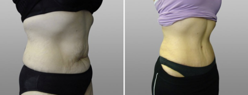 Tummy Tuck Photos 71 Abdominoplasty (Tummy Tuck) surgery, patient 16, before and after photos post-op 6 weeks
