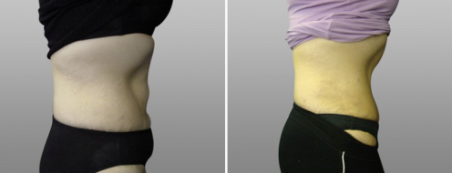 Tummy Tuck Photos 70 Abdominoplasty (Tummy Tuck) before and after photos post-op 6 weeks, images at Form & Face clinic, patient 4, side view