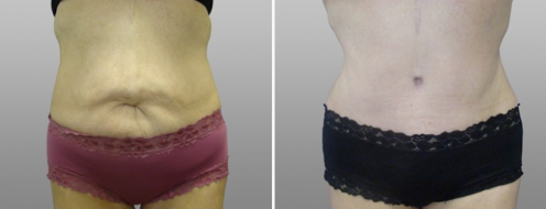 Tummy Tuck Photos 69 Patient 17, Abdominoplasty (Tummy Tuck), image 45, front view