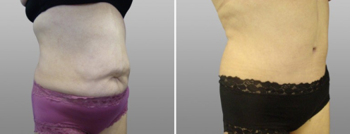 Tummy Tuck Photos 68 Abdominoplasty (Tummy Tuck) patient before and after surgery images, image 46, angle view