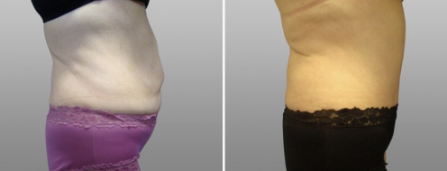 Tummy Tuck Photos 67 Abdominoplasty (Tummy Tuck) images, Dr Norris, patient 17