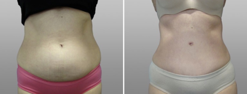 Tummy Tuck Photos 66 Abdominoplasty (Tummy Tuck) before and after photos post-op 6 weeks, image 48, front view
