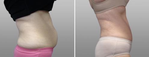 Tummy Tuck Photos 65 Patient 18, Abdominoplasty (Tummy Tuck) before and after photos post-op 6 weeks, side view