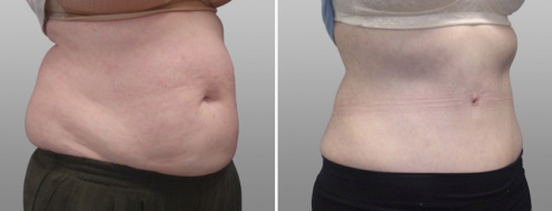 Abdominoplasty (Tummy Tuck) images, patient 2, before & after surgery photos, image 5