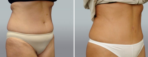 Patient 19, Abdominoplasty (Tummy Tuck) before and after image, angle view