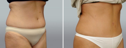Tummy Tuck Photos 64 Patient 19, Abdominoplasty (Tummy Tuck) before and after photos post-op 6 weeks, angle view