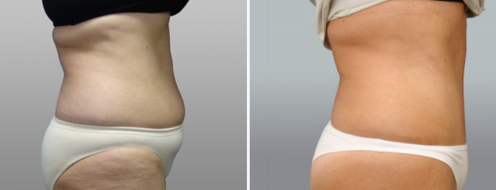 Tummy Tuck Photos 63 Abdominoplasty (Tummy Tuck)before and after photos post-op 6 weeks, patient 19, side view