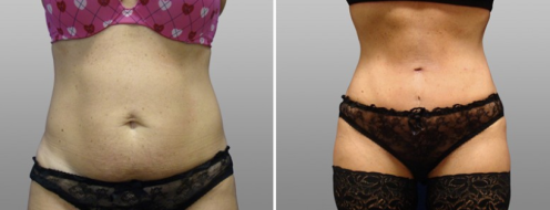 Tummy Tuck Photos 62 Abdominoplasty (Tummy Tuck) patient 21, front view, before and after photos post-op 6 weeks