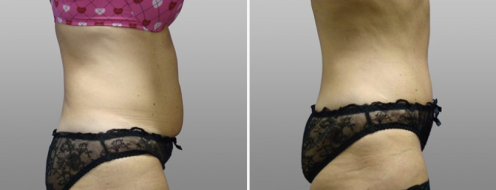 Patient 20, tummy tuck gallery, before and after surgery, side view