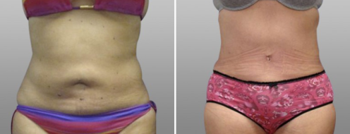 Tummy Tuck Photos 60 Abdominoplasty (Tummy Tuck) results, patient 21, Dr Norris, before and after photos post-op 6 weeks