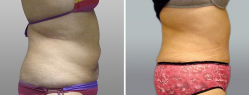 Tummy Tuck Photos 59 Abdominoplasty (Tummy Tuck) before and after photos post-op 6 weeks, patient 21, side view