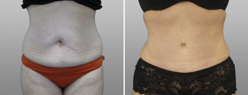 Tummy tuck gallery, before and after surgery, patient 22
