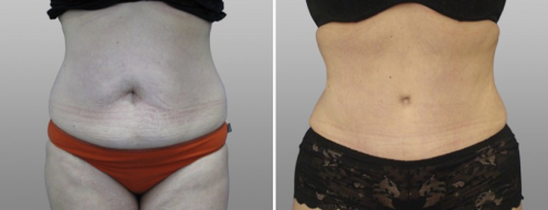Tummy Tuck Photos 58 Abdominoplasty (Tummy Tuck), before and after photos post-op 6 weeks, patient 22