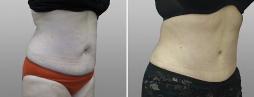 Tummy Tuck Photos 57 Patient 22, Abdominoplasty (Tummy Tuck) before and after photos post-op 6 weeks, side view