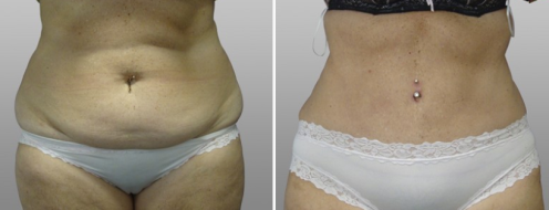 Tummy Tuck Photos 56 Abdominoplasty (Tummy Tuck), patient 23, front view, before and after photos post-op 6 weeks