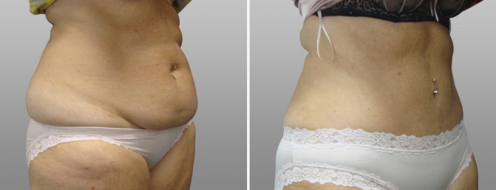 Tummy Tuck Photos 55 Abdominoplasty (Tummy Tuck) before and after photos post-op 6 weeks, patient 23, angle view