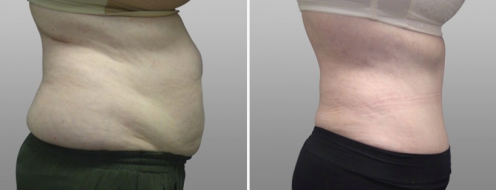 Tummy Tuck Photos 108 Abdominoplasty (Tummy Tuck) surgery, before and after photos post-op 6 weeks, patient 2