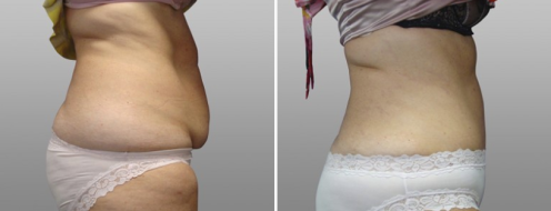Tummy tuck, patient 23, side view