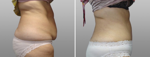 Tummy Tuck Photos 54 Abdominoplasty (Tummy Tuck), patient 23, side view, before and after photos post-op 6 weeks