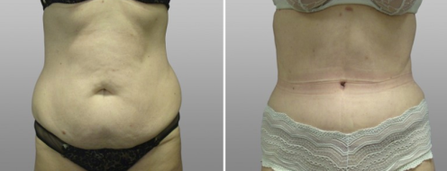 Tummy Tuck Photos 53 Abdominoplasty (Tummy Tuck) results with Dr Norris, image 61, front view, before and after photos post-op 6 weeks