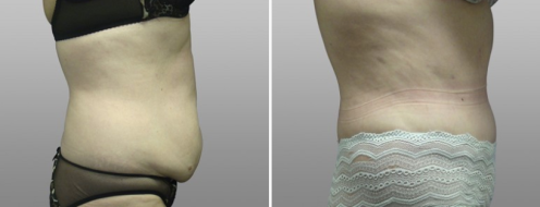 Tummy Tuck Photos 52 Abdominoplasty (Tummy Tuck)before and after photos post-op 6 weeks, patient 24, side view