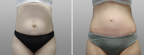 Abdominoplasty surgery results, image 63, Dr Norris