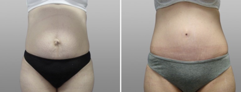 Tummy Tuck Photos 51 Abdominoplasty (Tummy Tuck) surgery results, image 63, Dr Norris, before and after photos post-op 6 weeks