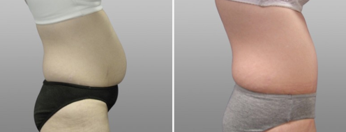 Side view, patient before and after tummy tuck, image 64