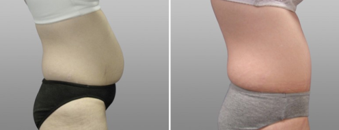 Tummy Tuck Photos 50 Side view, patient before and after photos post-op 6 weeks of Abdominoplasty (Tummy Tuck), image 64