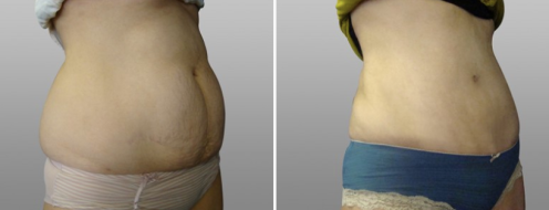 Before and after abdominoplasty, patient 10, before & after image
