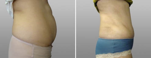Tummy Tuck Photos 48 Abdominoplasty (Tummy Tuck) patient 10, side view, before and after photos post-op 6 weeks