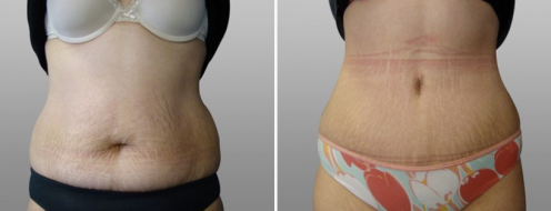 Tummy Tuck Photos 47 Abdominoplasty (Tummy Tuck) patient 27, front view, Dr Norris, image 67, before and after photos post-op 6 weeks