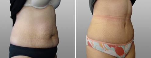 Tummy Tuck Photos 46 Patient 27, Abdominoplasty (Tummy Tuck) plastic surgery procedure before and after photos post-op 6 weeks, angle view
