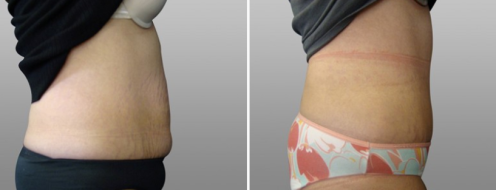 Tummy Tuck Photos 45 Abdominoplasty (Tummy Tuck), patient 27, before and after photos post-op 6 weeks, side view