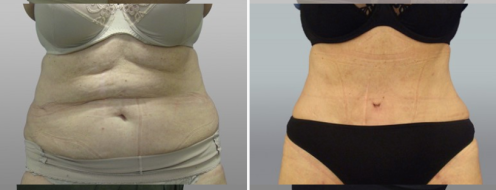 Tummy Tuck Photos 107 Abdominoplasty (Tummy Tuck) surgery, patient 3, front view, before and after photos post-op 6 weeks