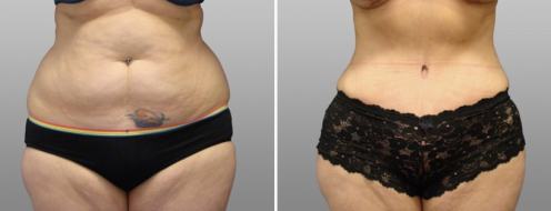 Before and after tummy tuck, patient 28, front view