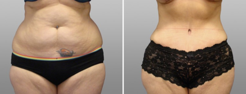 Tummy Tuck Photos 44 Abdominoplasty (Tummy Tuck)before and after photos post-op 6 weeks, patient 28, front view