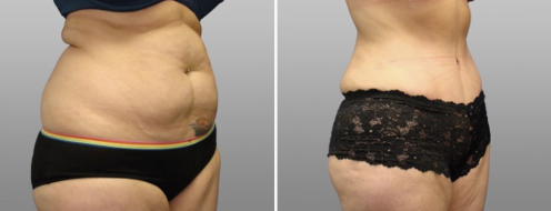 Tummy Tuck Photos 43 Abdominoplasty (Tummy Tuck) with Dr Norris, patient 28, angle view, before and after photos post-op 6 weeks