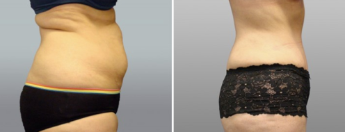 Tummy Tuck Photos 42 Patient 28 Abdominoplasty (Tummy Tuck) before and after photos post-op 6 weeks, side view