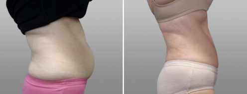 Tummy Tuck Photos 41 Abdominoplasty (Tummy Tuck) before and after photos post-op 6 weeks, patient 18, side view