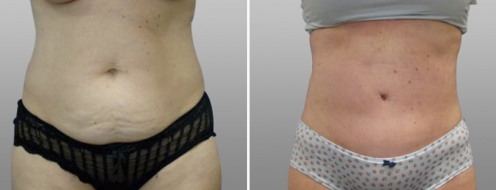 Tummy tuck, patient 30, front view