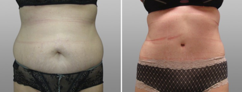 Tummy Tuck Photos 39 Patient 31, Abdominoplasty (Tummy Tuck) before and after photos post-op 6 weeks, image 75, front view