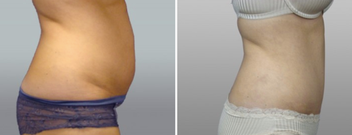 Tummy Tuck Photos 38 Patient 32, Abdominoplasty (Tummy Tuck) surgery before and after photos post-op 6 weeks, side view