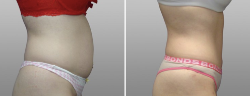 Tummy Tuck Photos 37 Abdominoplasty (Tummy Tuck) surgery at Form & Face clinic in Sydney, patient 33, before and after photos post-op 6 weeks