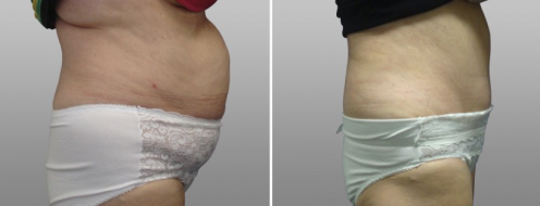 Tummy Tuck Photos 36 Form & Face, Abdominoplasty (Tummy Tuck) before and after photos post-op 6 weeks, patient 34, side view
