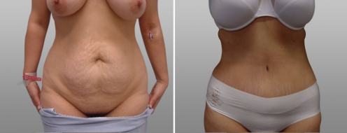 Tummy tuck image gallery, patient 35, before & after surgery